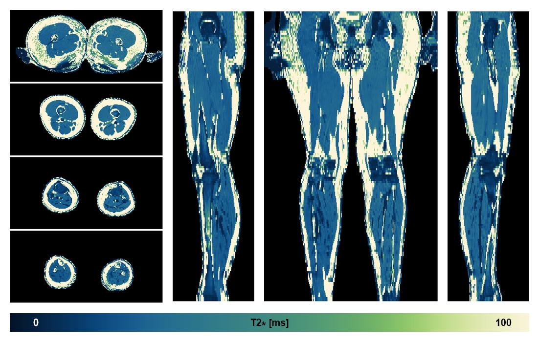 The T2 star relaxation time of the lower extremity obtained from the dixon reconstruction for muscle water fat quantification.